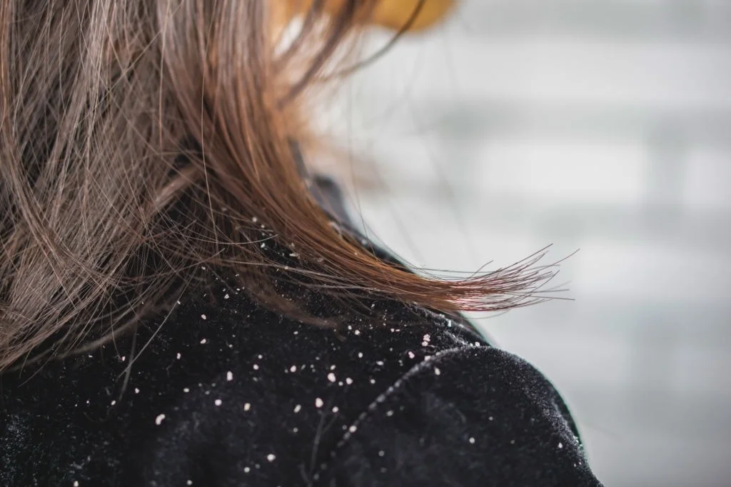 Dandruff Remedy 2 olive oil curing dandruff